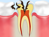 神経のむし歯  