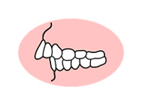 上の前歯が突き出ている（出っ歯）
