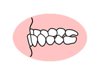 下の前歯が突き出ている（受け口）