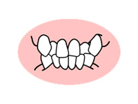歯がでこぼこに生えている（叢生）