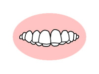 噛み合わせが深すぎる（過蓋咬合）